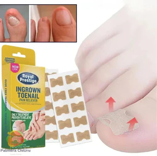Ingrown Toenails and Fungal Infections