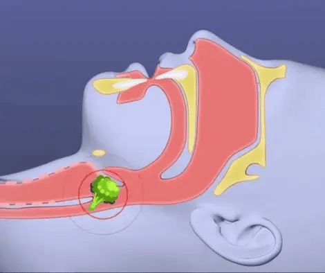 Vital capacity trainer+anti-Choking Device